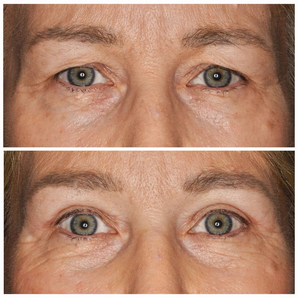 Before and after: Upper eyelid blepharoplasty