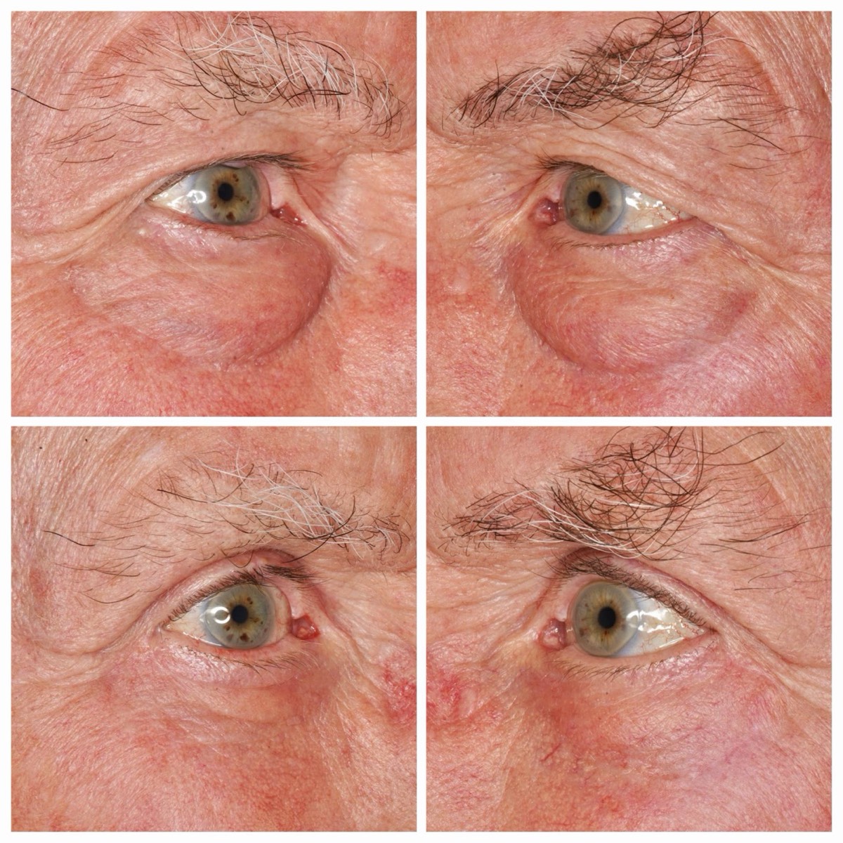 Before and after: Upper and lower eyelid blepharoplasty, side views