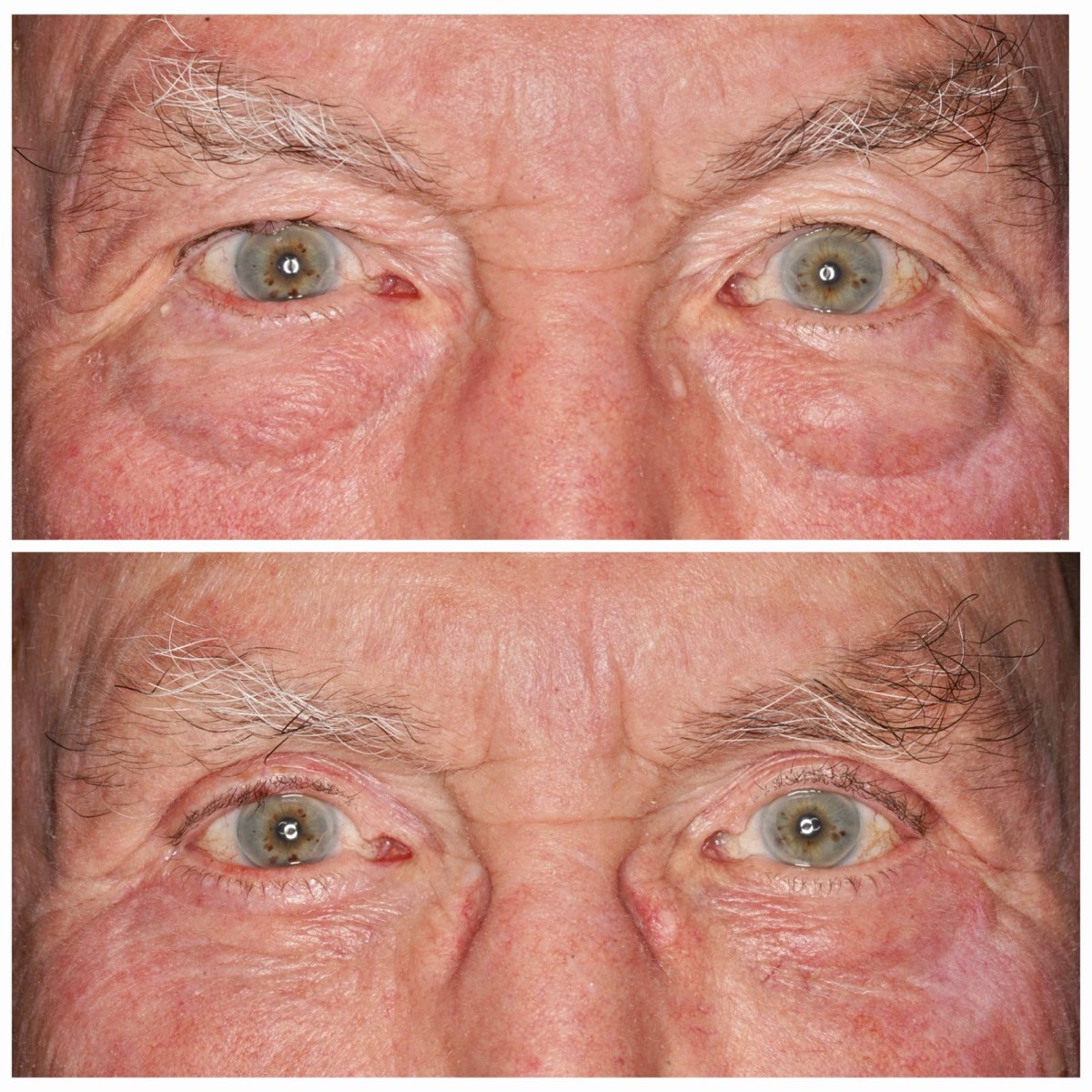 Before and after: Upper and lower eyelid blepharoplasty