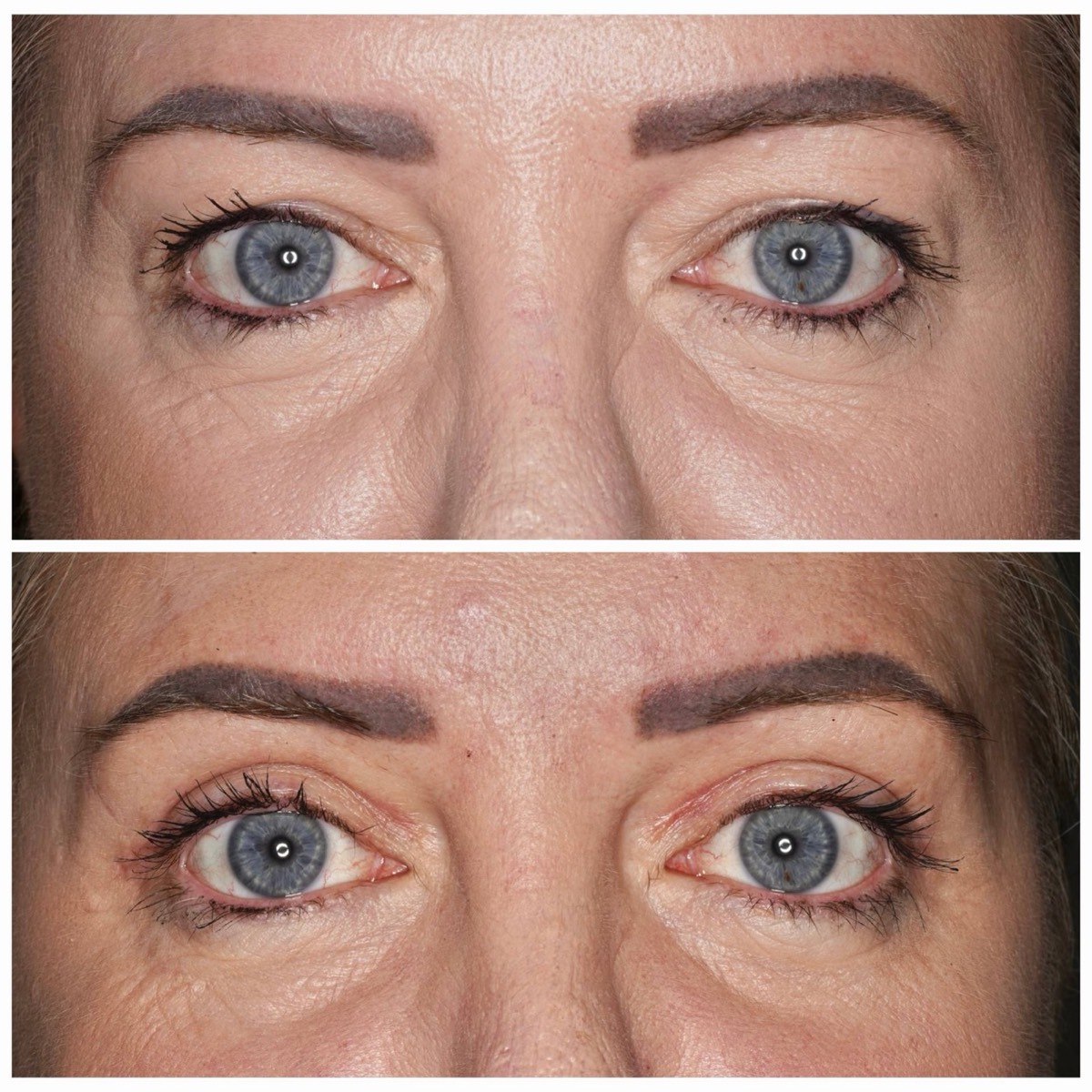 Before and after: Upper eyelid blepharoplasty