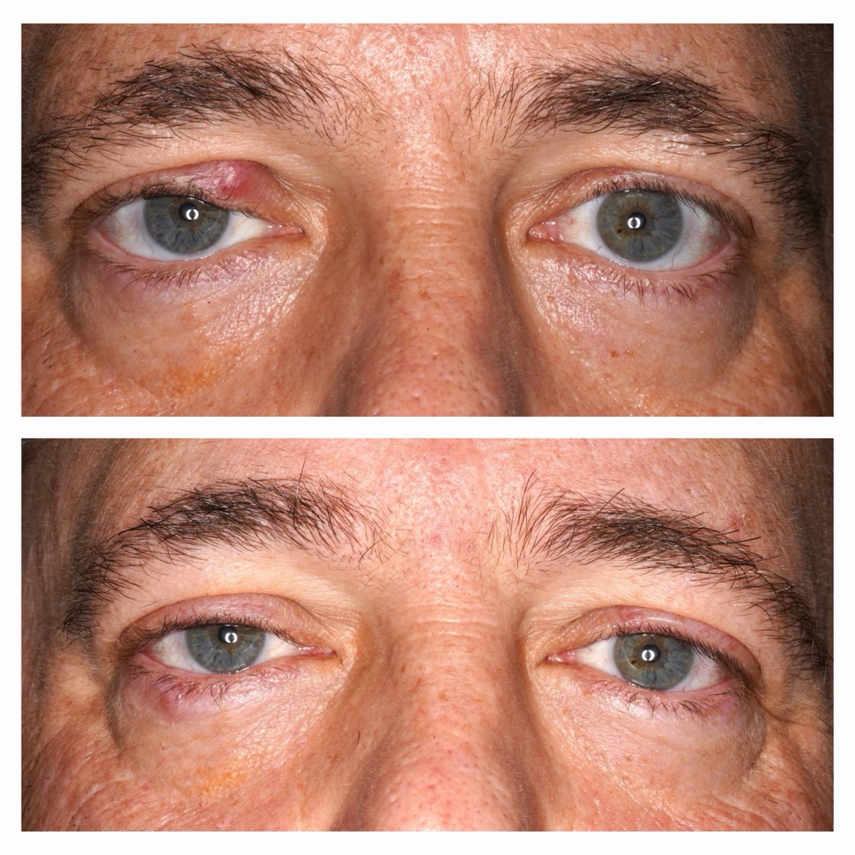 Before and after: Chalazion (eyelid cyst) removal