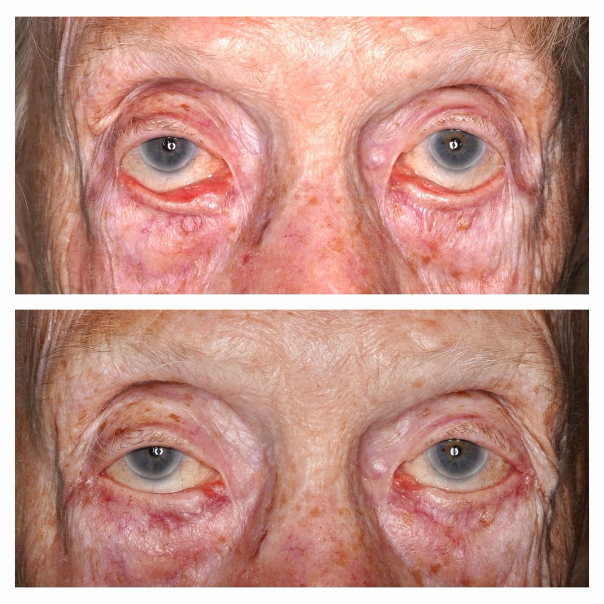 Before and after: Ectropion repair, lower eyelids
