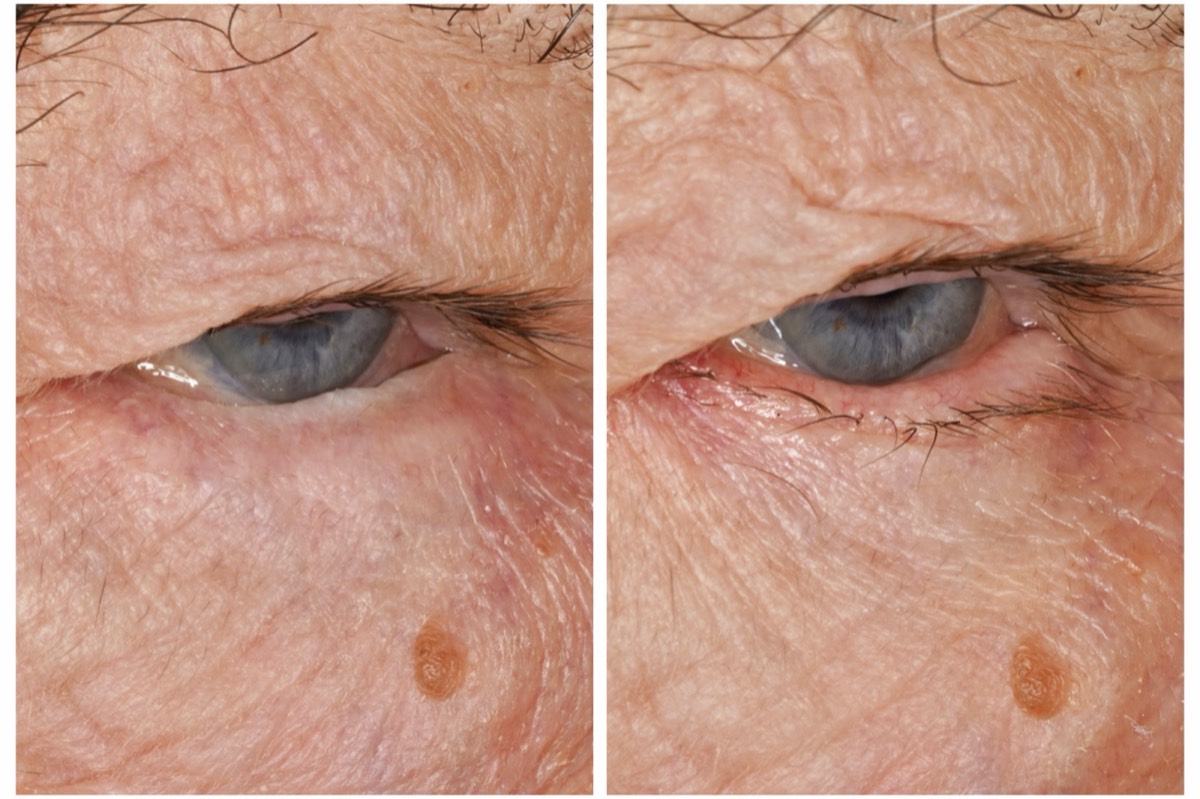 Before and after: Entropion repair, lower eyelid