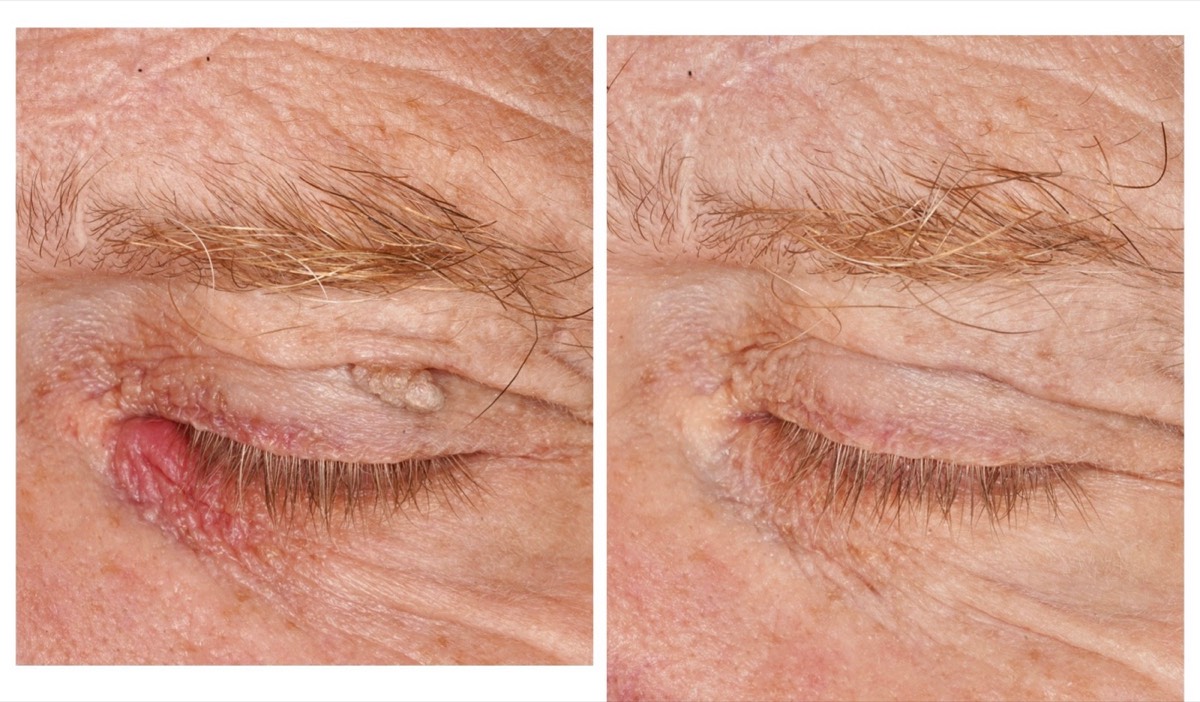 Before and after: Eyelid lump removal