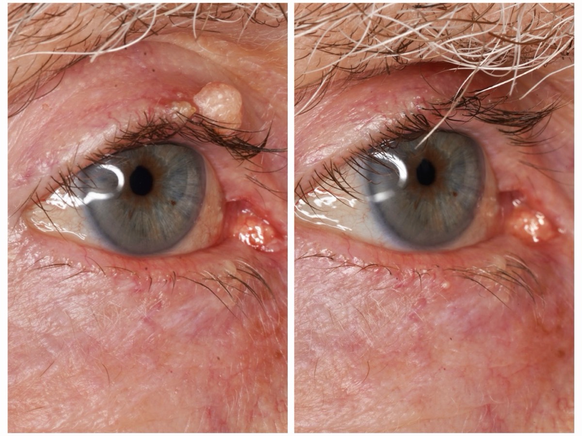 Before and after: Eyelid lump removal