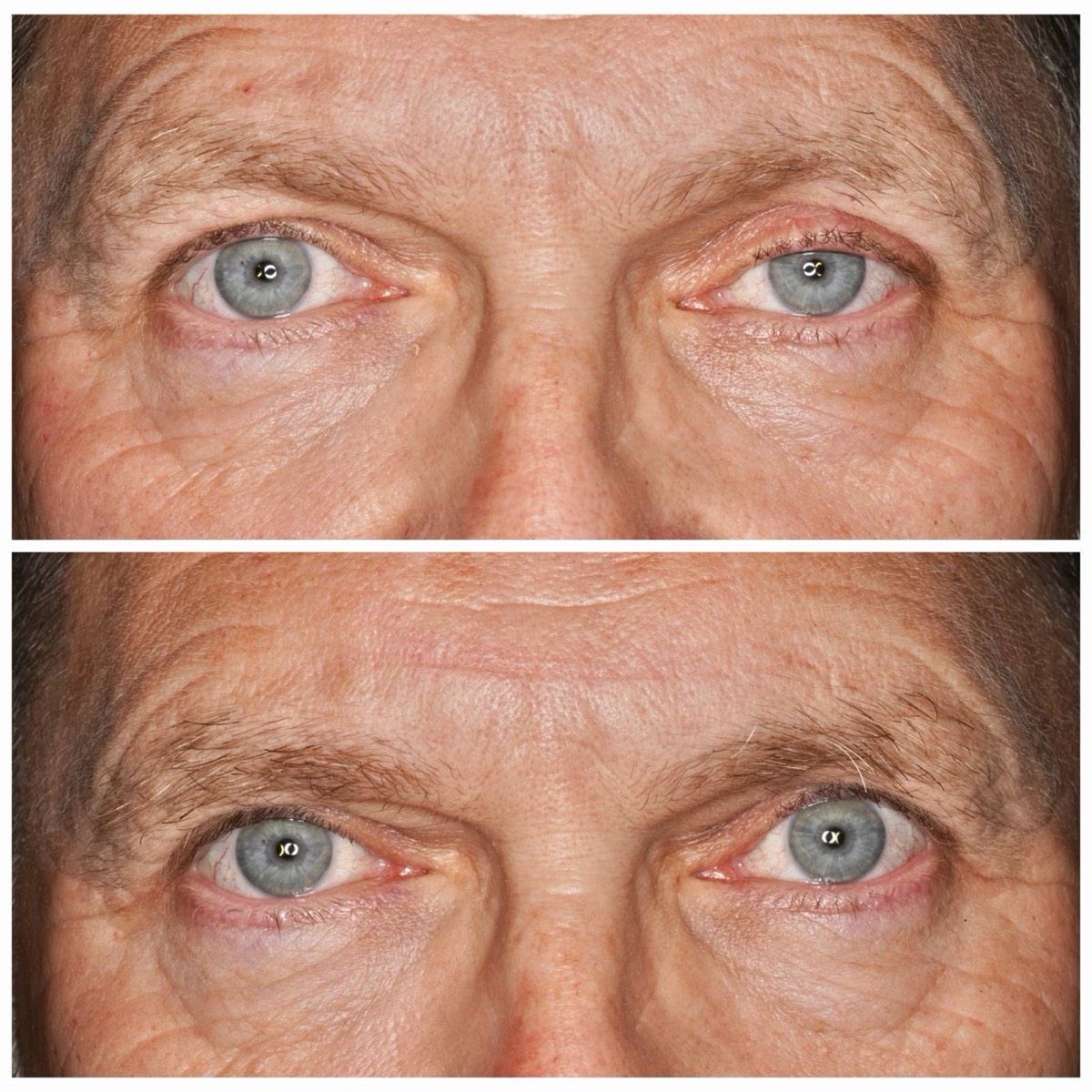 Before and after: Ptosis repair