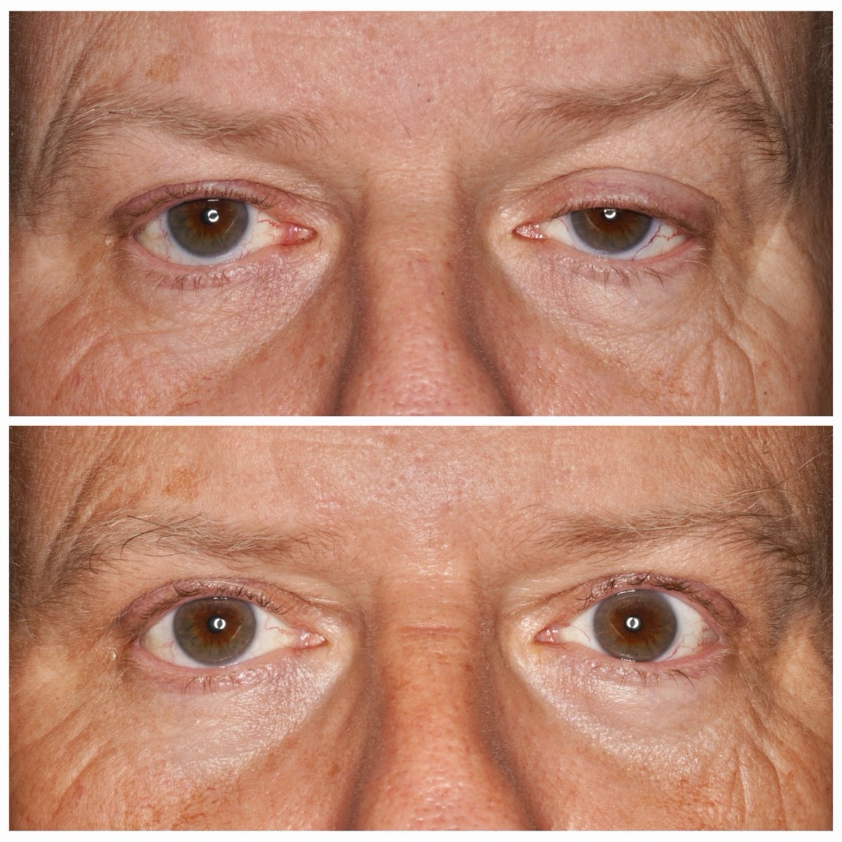 Before and after: Ptosis repair