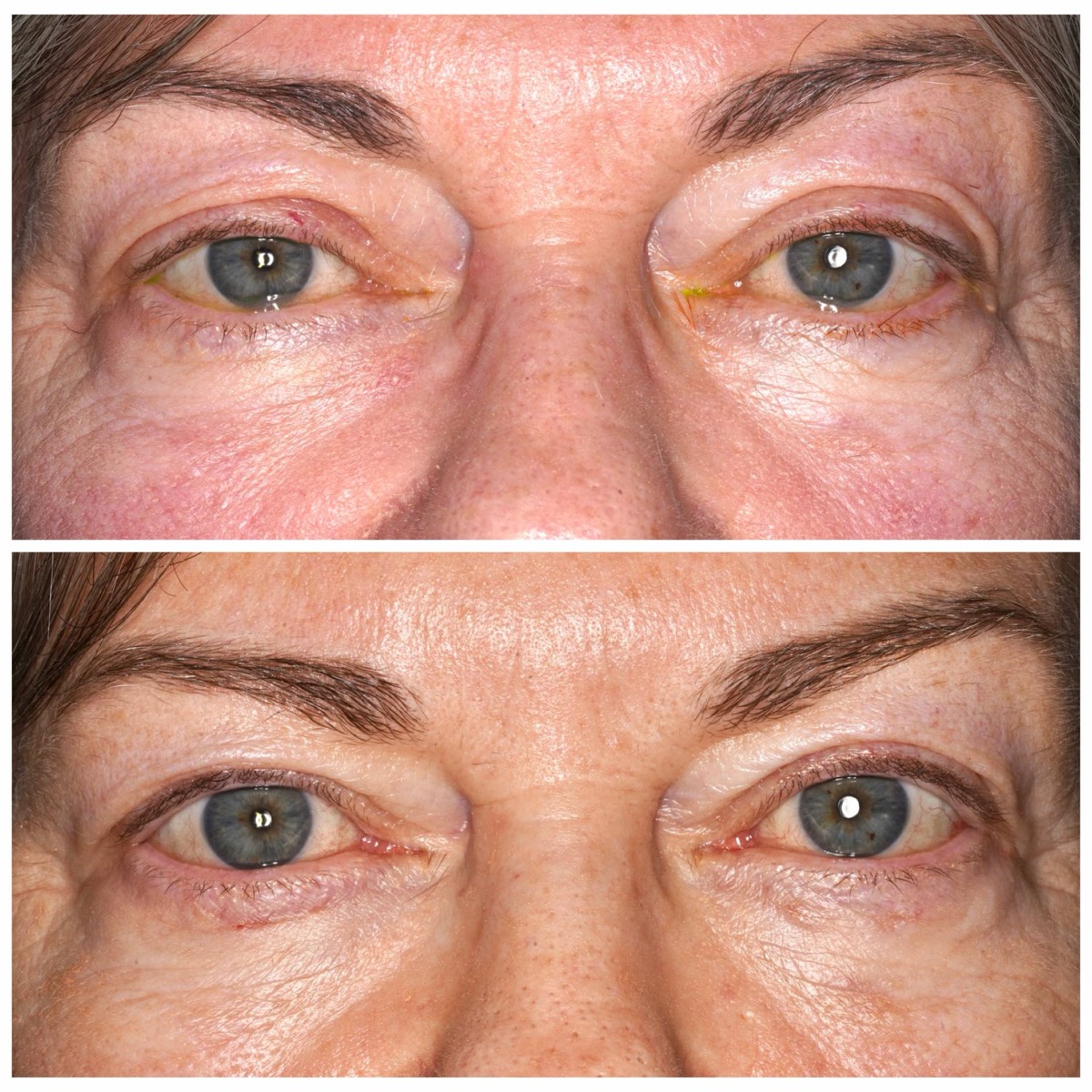 Before and after: Treatment for watery eyes