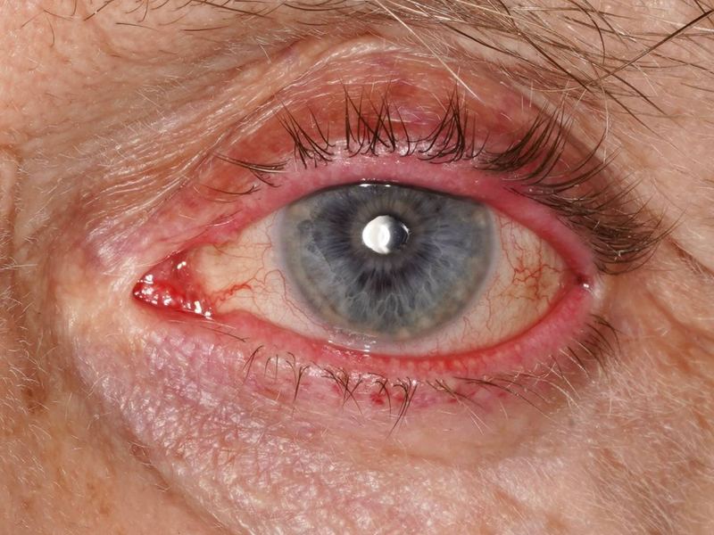 Eye with red, inflamed eyelid margins