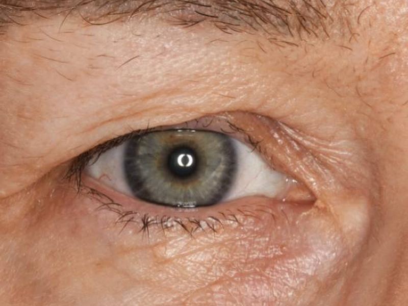 Eye with heavy, hooded upper eyelid skin