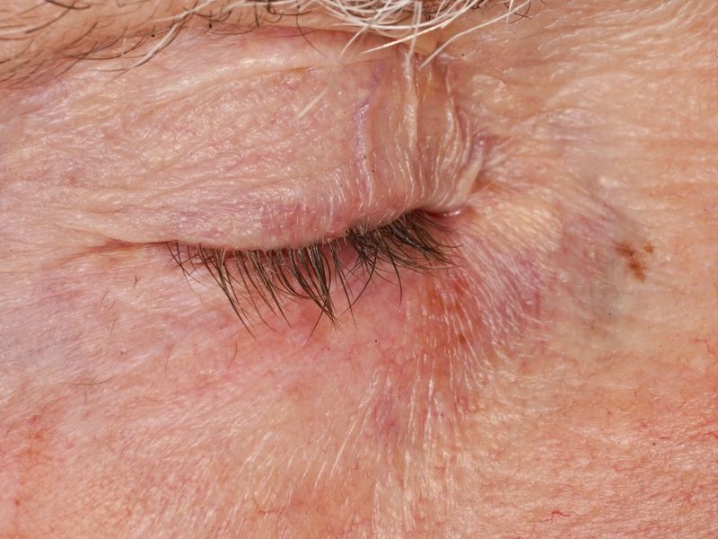Eyelid tightly closed in spasm
