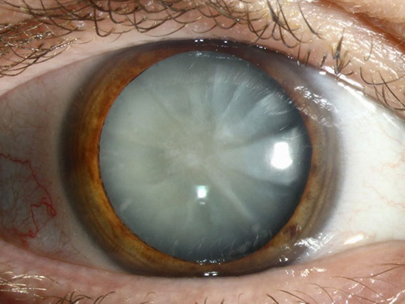 Close-up of an eye with a cataract