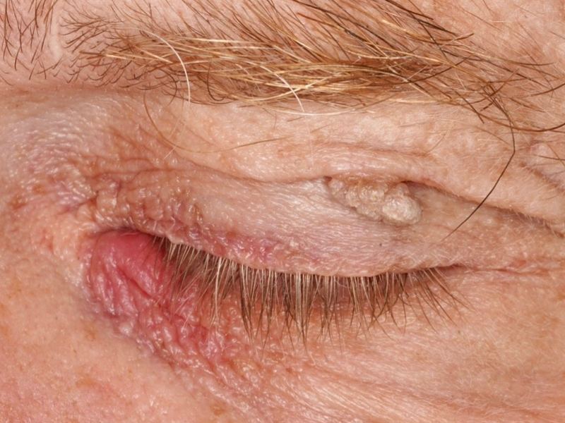 Closed eye with lumps on the eyelids