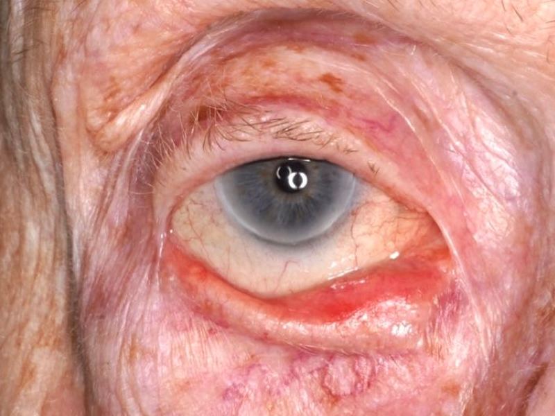 Eye with an outward-turning lower eyelid