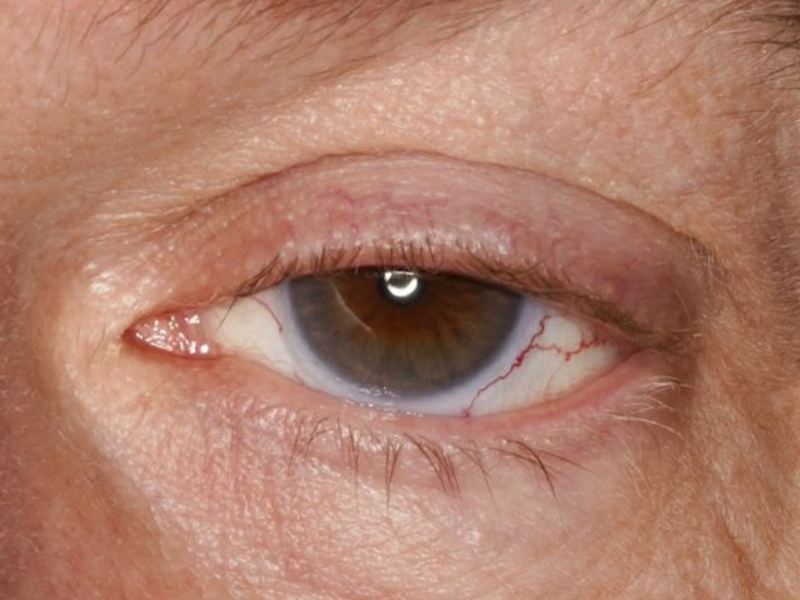 Eye with a drooping upper eyelid