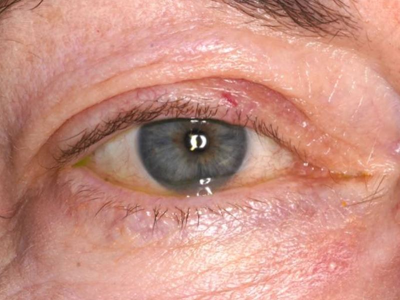 Watery eye